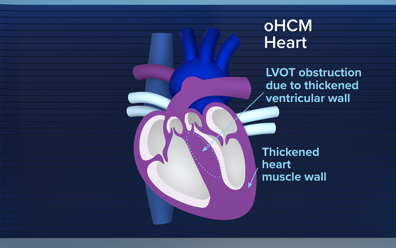 OHCM Heart Obstruct